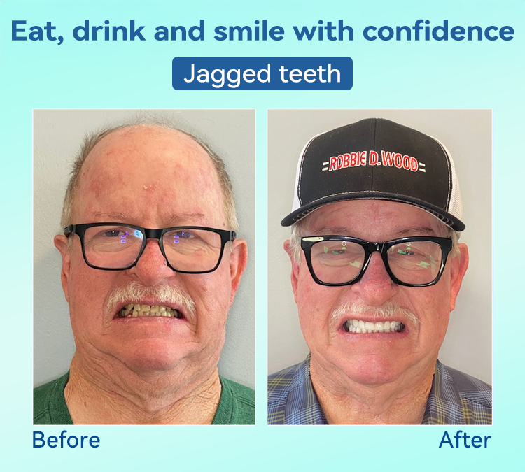 FlexiSmile Dentures - A Secure Smile, A Youthful Face + 50% OFF