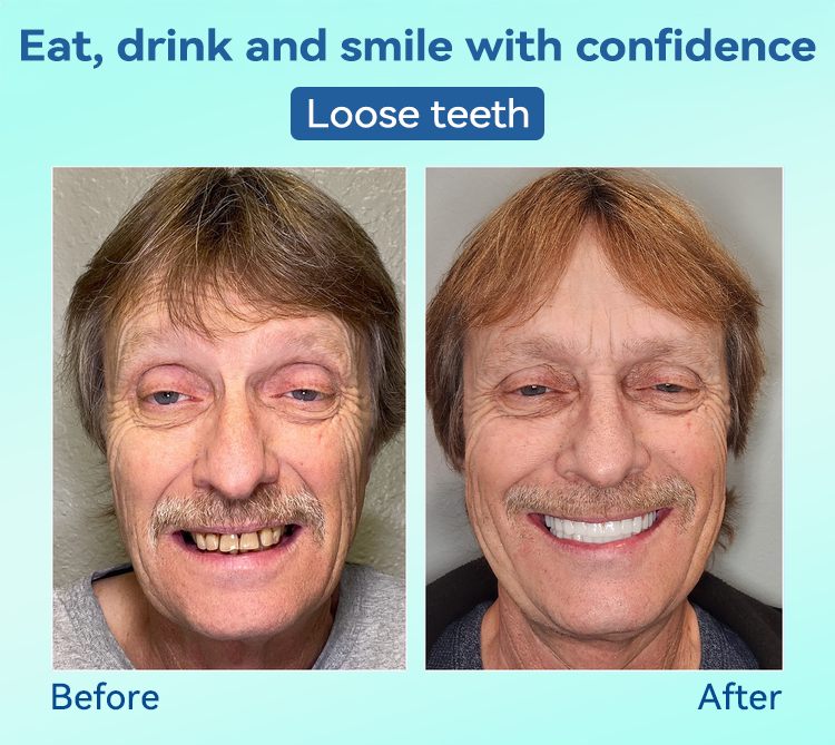 FlexiSmile Dentures - A Secure Smile, A Youthful Face + 50% OFF