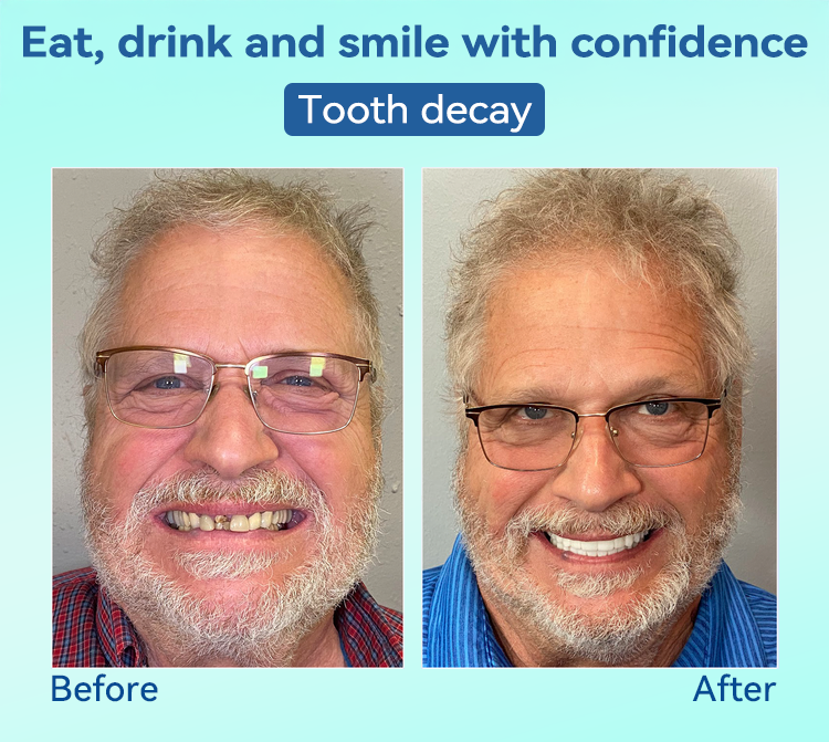 FlexiSmile Dentures - A Secure Smile, A Youthful Face + 50% OFF