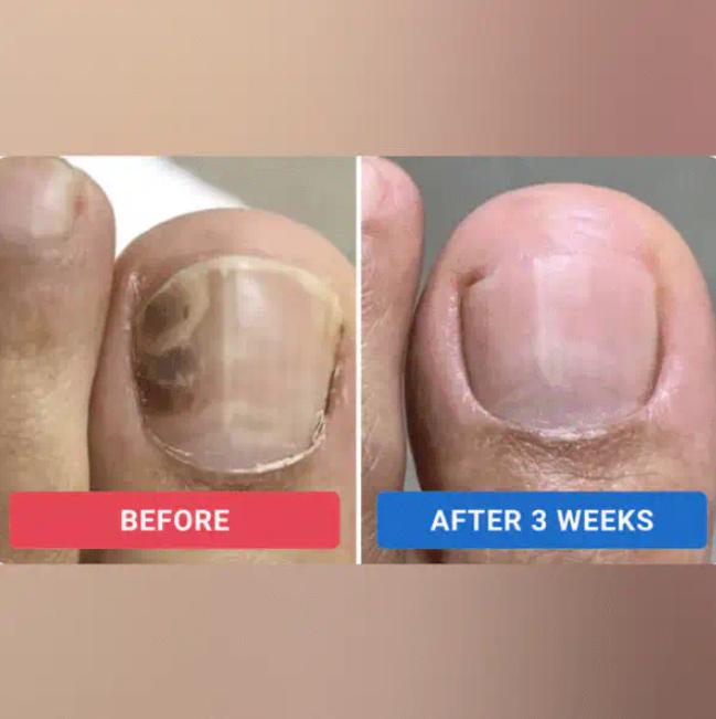 The NailRenew Overnight Patch - Healthier Nails While You Sleep + 50% OFF