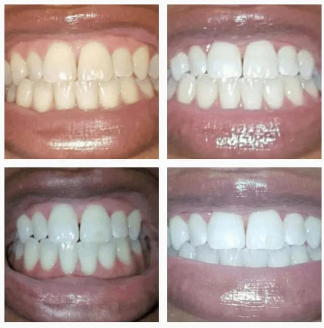 LumiWhite Serum Pen - Your Dual-Action Whitening Solution - 1+1 FREE