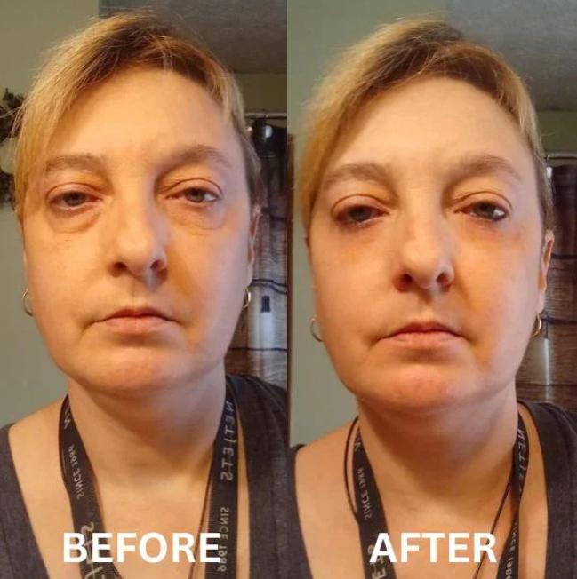 CryoGlow Patches - A Camera-Ready Look in 60 Minutes - 50% OFF