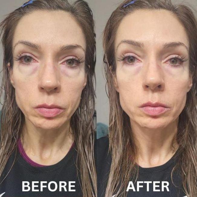 CryoGlow Patches - A Camera-Ready Look in 60 Minutes - 50% OFF
