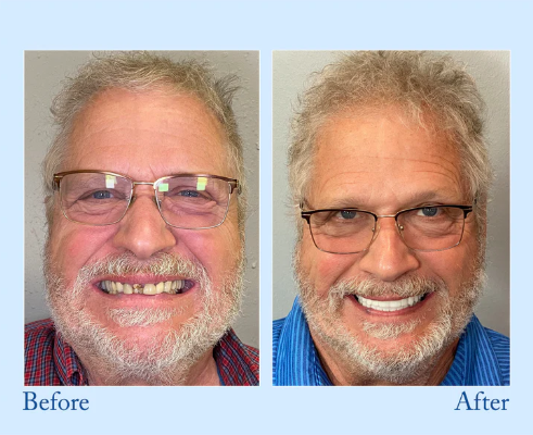 SmileRenew Pro Dentures ¨C Advanced Dentures for a Natural, Confident Smile - 50% OFF