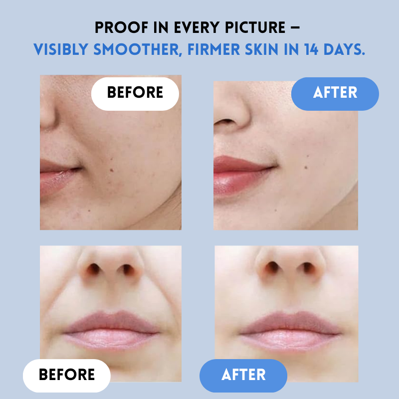 YouthLift Renew Strips ¨C The Instant Solution for Timeless Beauty - Buy More Save More