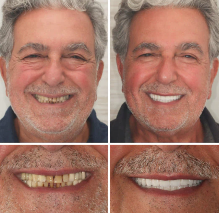 Comfort-Fit Flexible Dentures ¨C Natural Look Easy Wear & Removal - 60% OFF