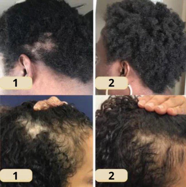 The EELHOE Natural Growth Oil - Rosemary, Castor, and Green Coffee for Thicker, Fuller Hair +  50% OFF