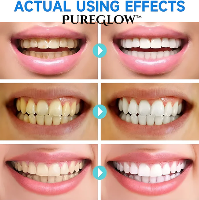 The AuraGlow Whitening Gel - Niacinamide Brightening, Enamel Repair, and Day Results + 50% OFF